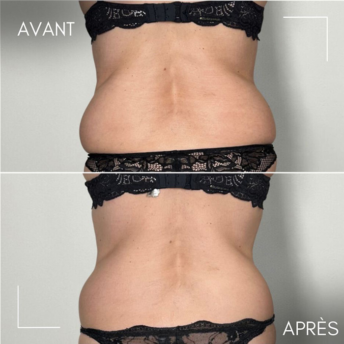 Résultats avant/après séances de cryolipolyse