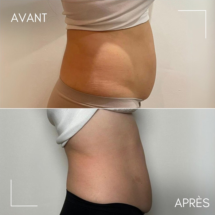 Résultats avant/après séances de cryolipolyse