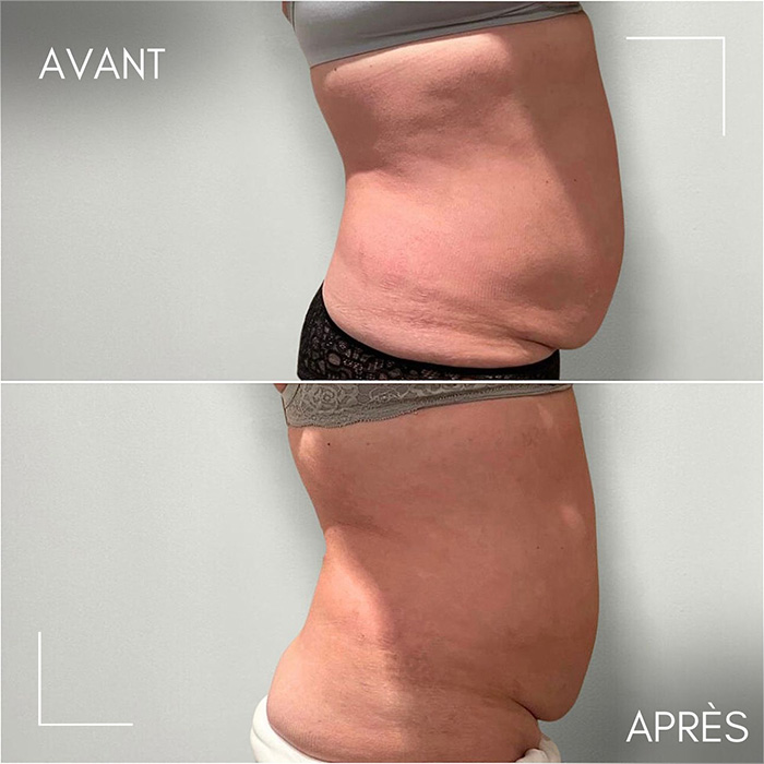 Résultats avant/après séances de cryolipolyse