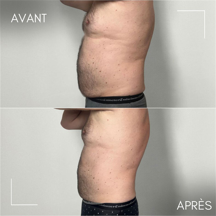 Résultats avant/après séances de cryolipolyse
