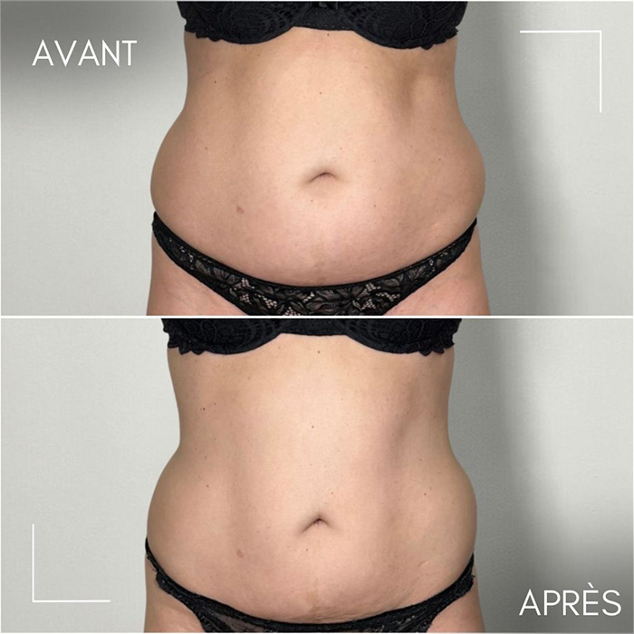 Résultats avant/après séances de cryolipolyse