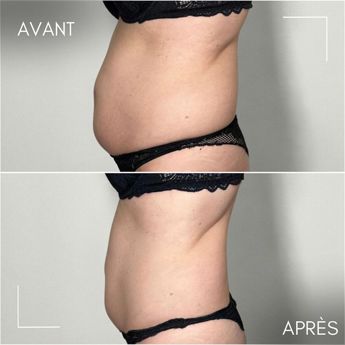 Résultats avant/après séances de cryolipolyse
