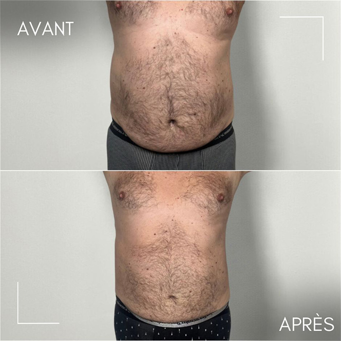 Résultats avant/après séances de cryolipolyse