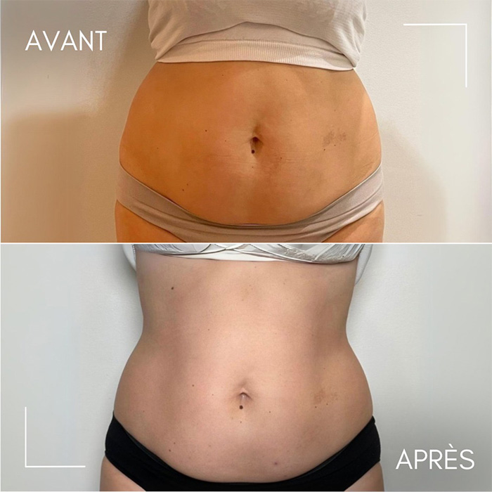 Résultats avant/après séances de cryolipolyse