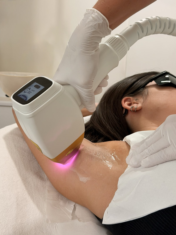 Épilation définitive au laser diode à Nice